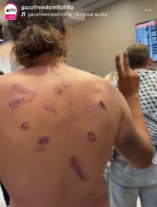 A shirtless person displays numerous circular and linear welts and bruising across their back, with another individual in a checkered scarf making a two-finger gesture nearby.