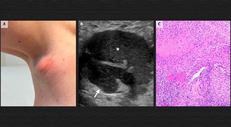 A three-panel medical figure: (A) a swollen lump on an armpit, (B) a grayscale ultrasound showing a dark lesion marked with an asterisk and arrow, and (C) a pink-stained histological tissue sample.