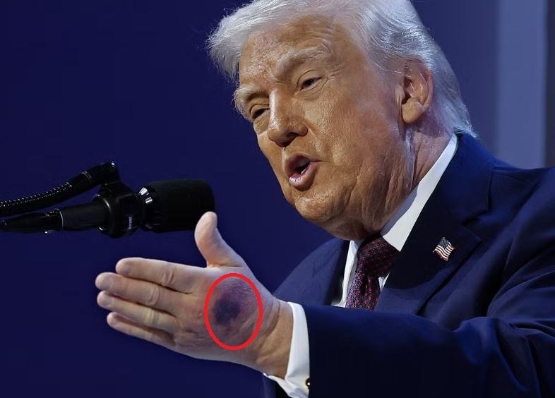 A white-haired man in a navy suit speaks at a microphone, gesturing with his hand to reveal a circular bruise circled in red on the back.